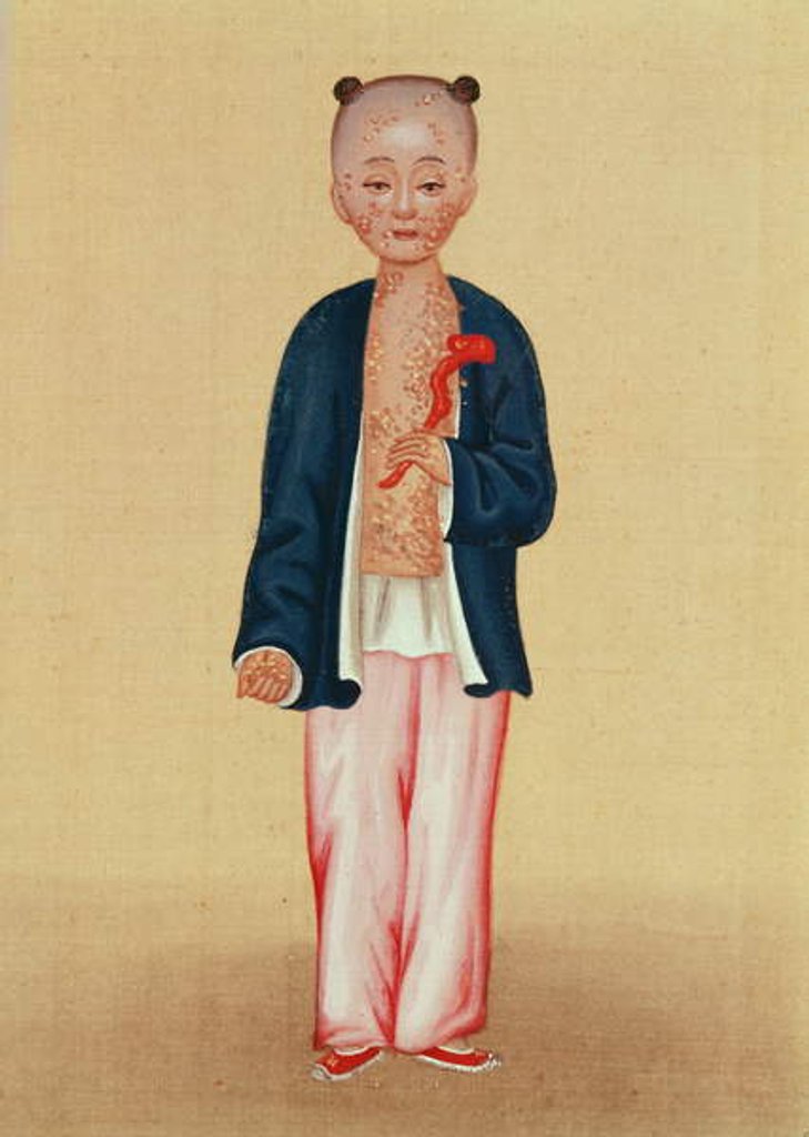 Detail of Child with smallpox by School Chinese