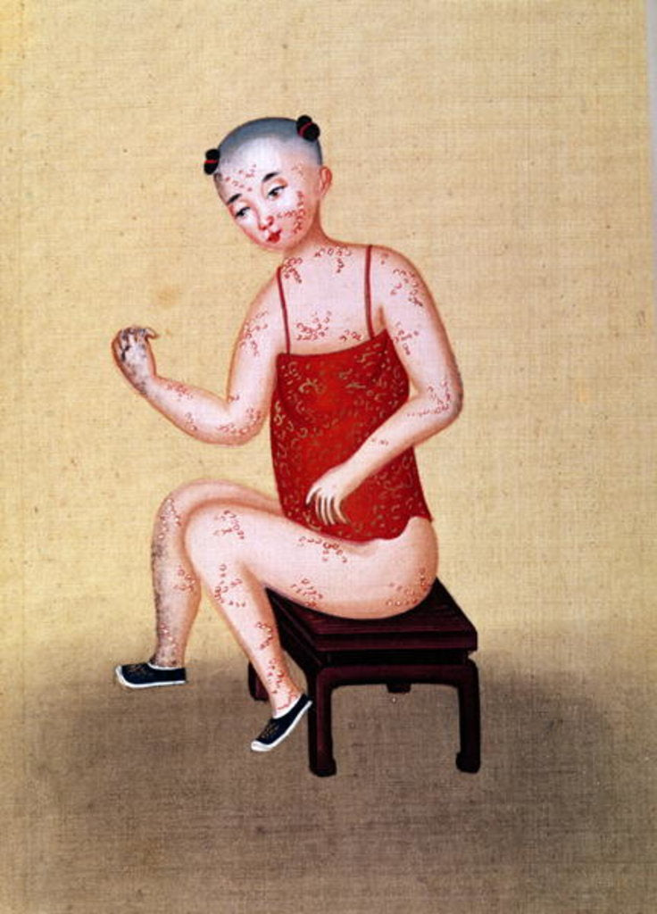 Detail of Child with smallpox by School Chinese