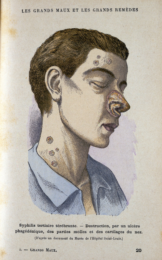 Detail of Symptoms of the tertiary phase of syphilis, c19th century by Unknown
