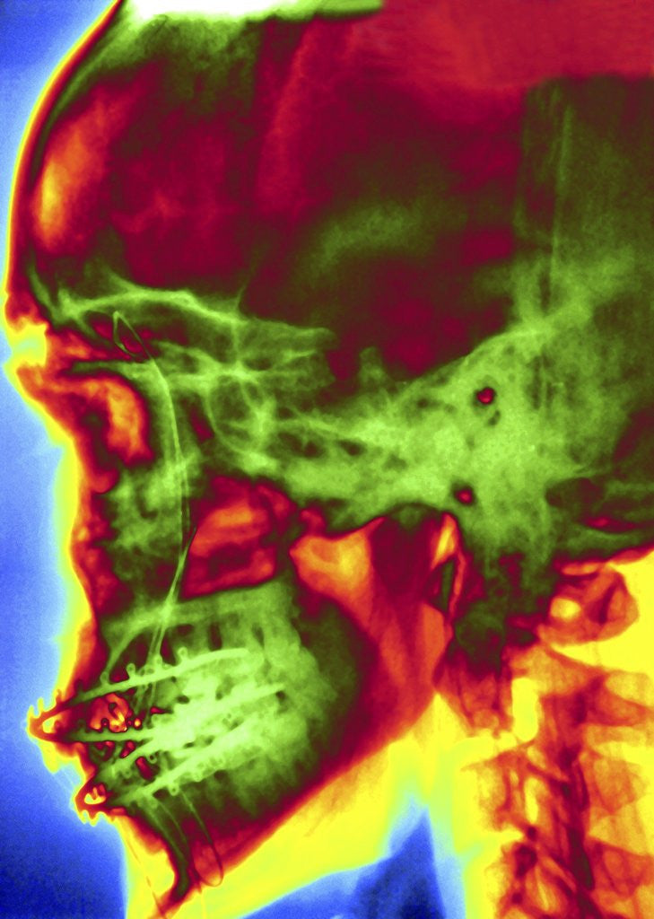 Detail of X-ray of Skull With Jaw Wiring by Anonymous