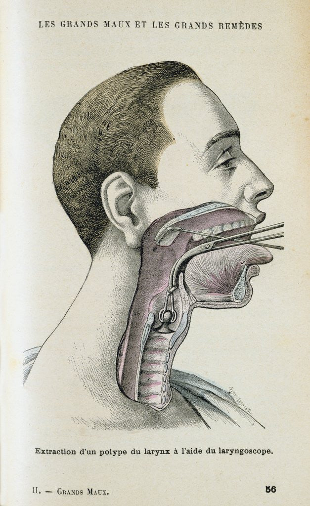 Detail of Polyp removal by Anonymous