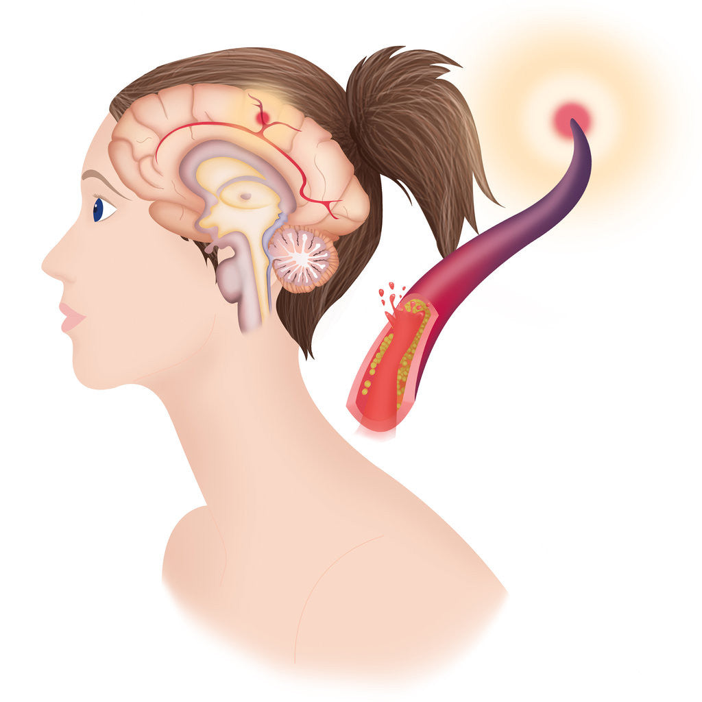 Detail of Cerebrovascular neurol. disease by Anonymous