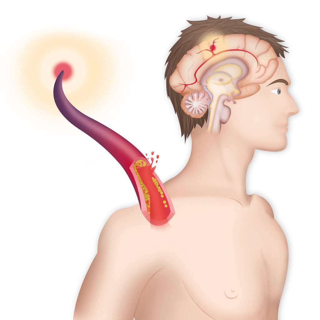 Detail of Cerebrovascular neurol. disease by Anonymous