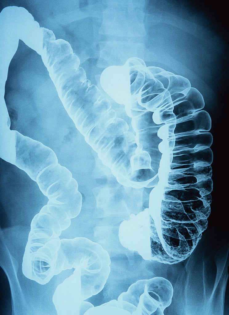 Detail of X-Ray of Intestines by Anonymous