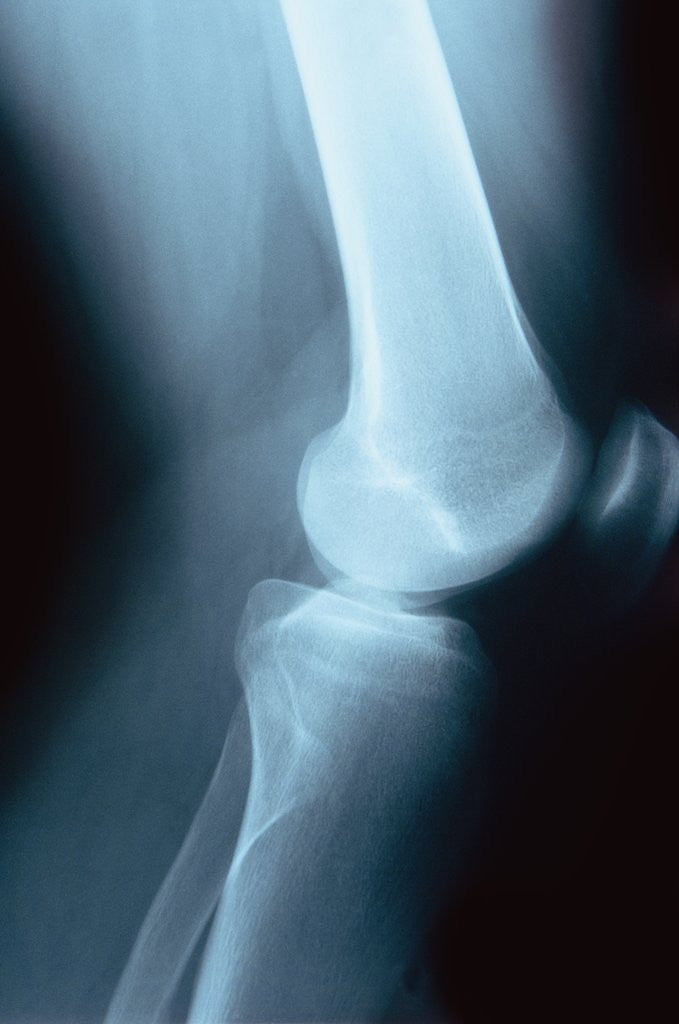Detail of Knee Joint X-Ray by Anonymous