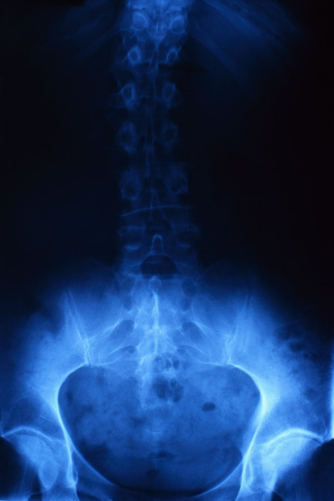 Detail of X-Ray of Human Lower Spine by Anonymous