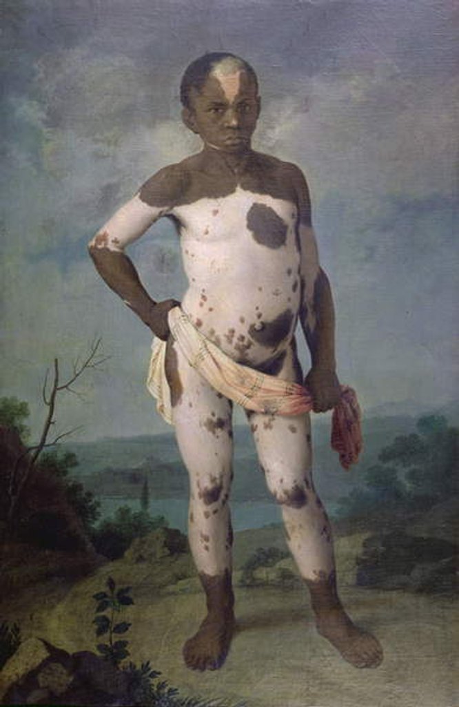 Child with Vitiligo, 1786 by Brazilian School