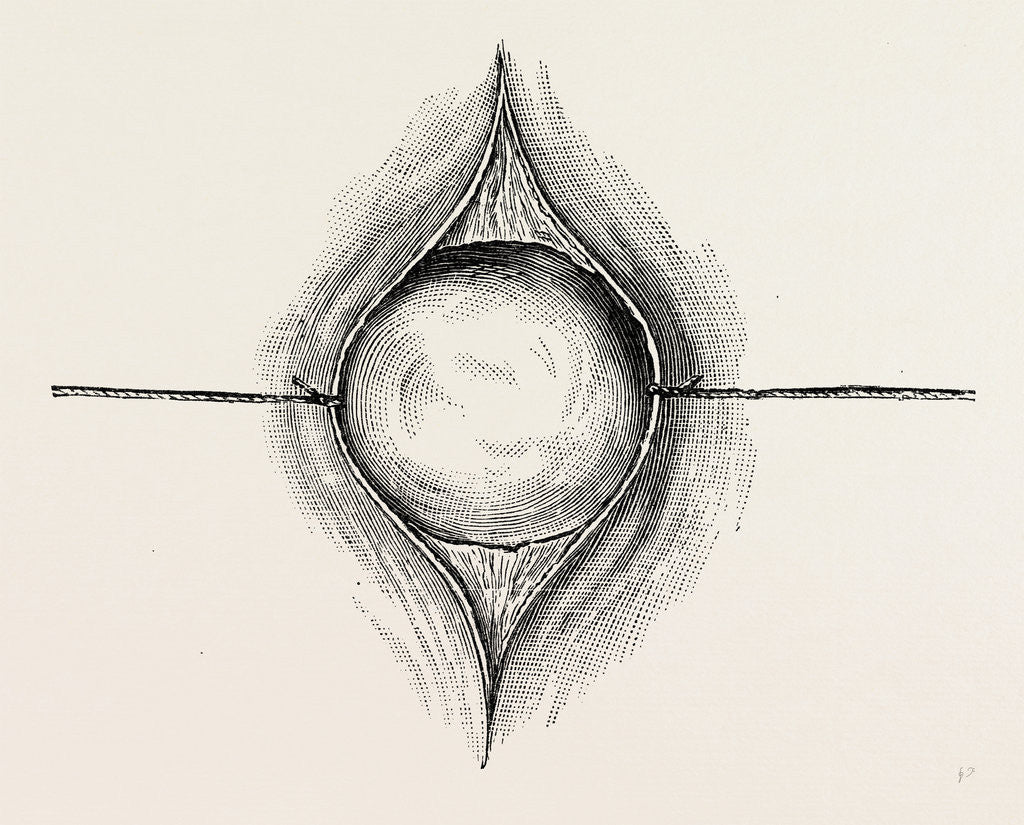 Detail of Mode of exposing a tumour by ligature or threat retractors by Anonymous