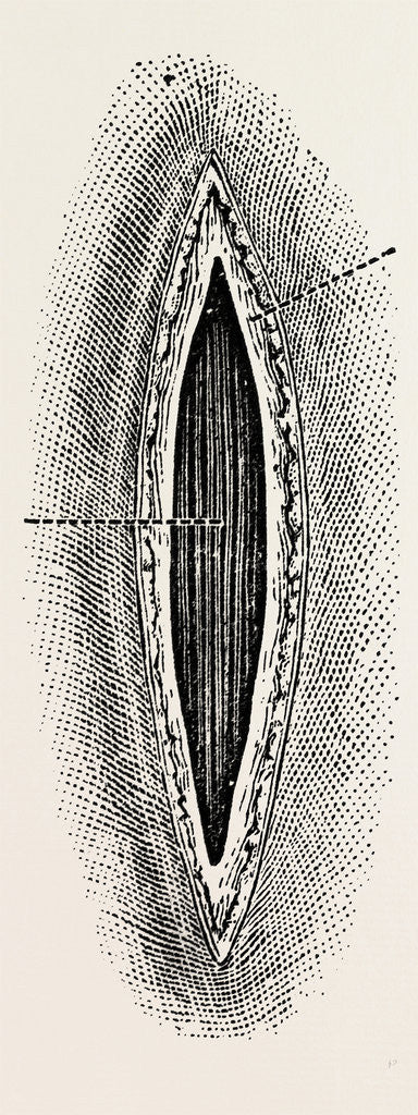 Detail of Ligatuite of the right radial by Anonymous
