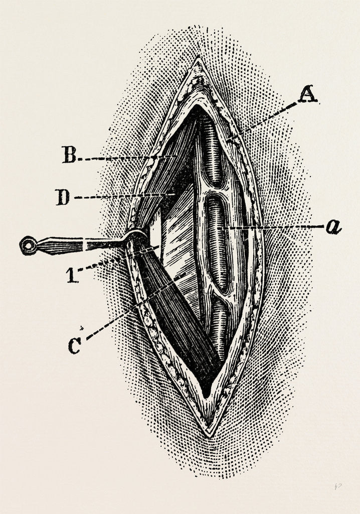Detail of Ligatuite of the right radial by Anonymous
