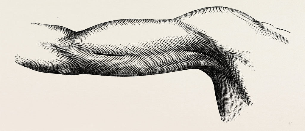 Detail of Ligature of the brachial about the middle of the arm by Anonymous