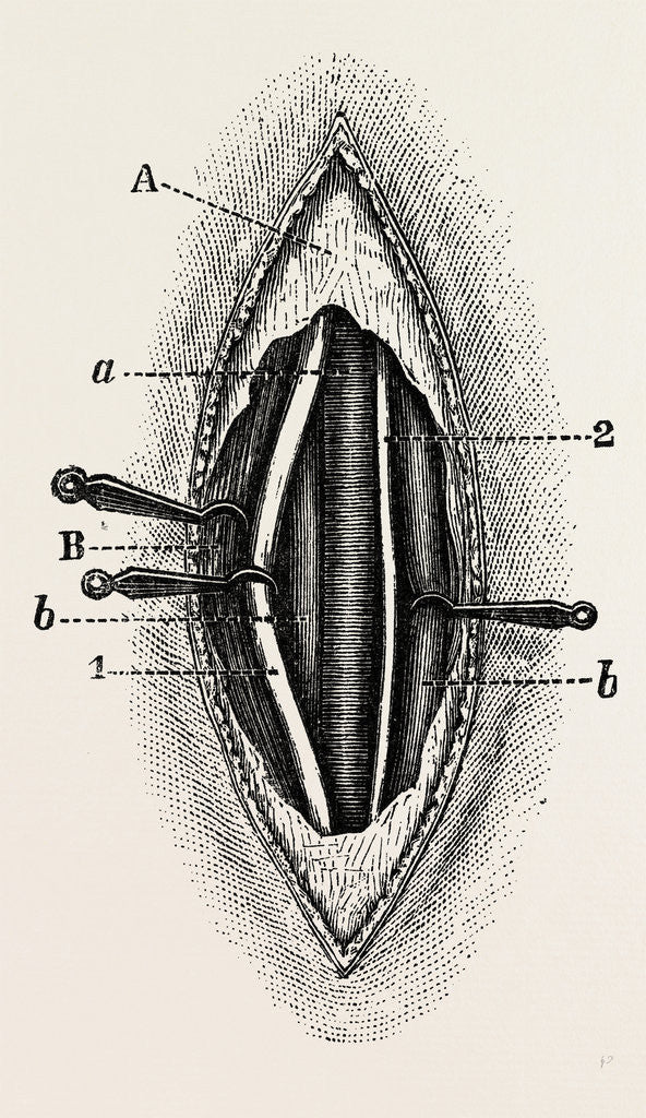 Detail of Ligature of the right finger by Anonymous