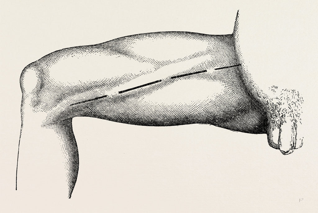Detail of Ligature of the right common femoral at the base of scarpa's by Anonymous