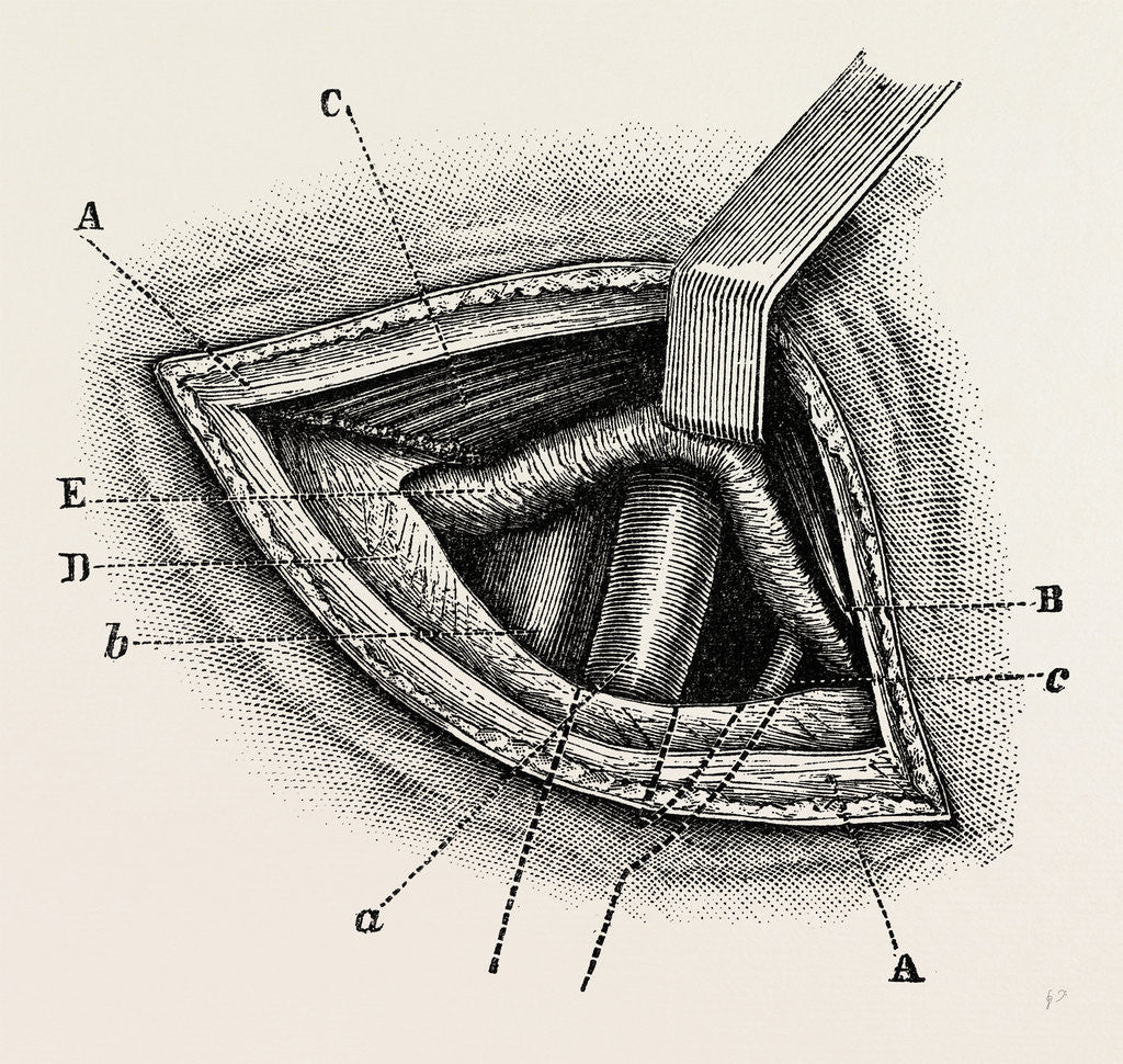 Detail of Ligature of right external iliac artery by Anonymous