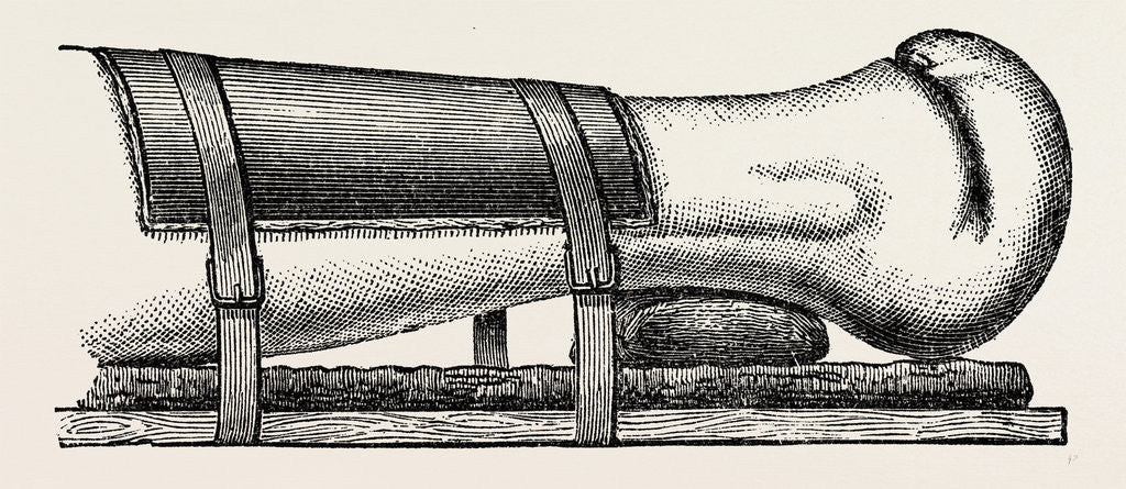 Detail of Supporting splint adjusted to the leg by Anonymous