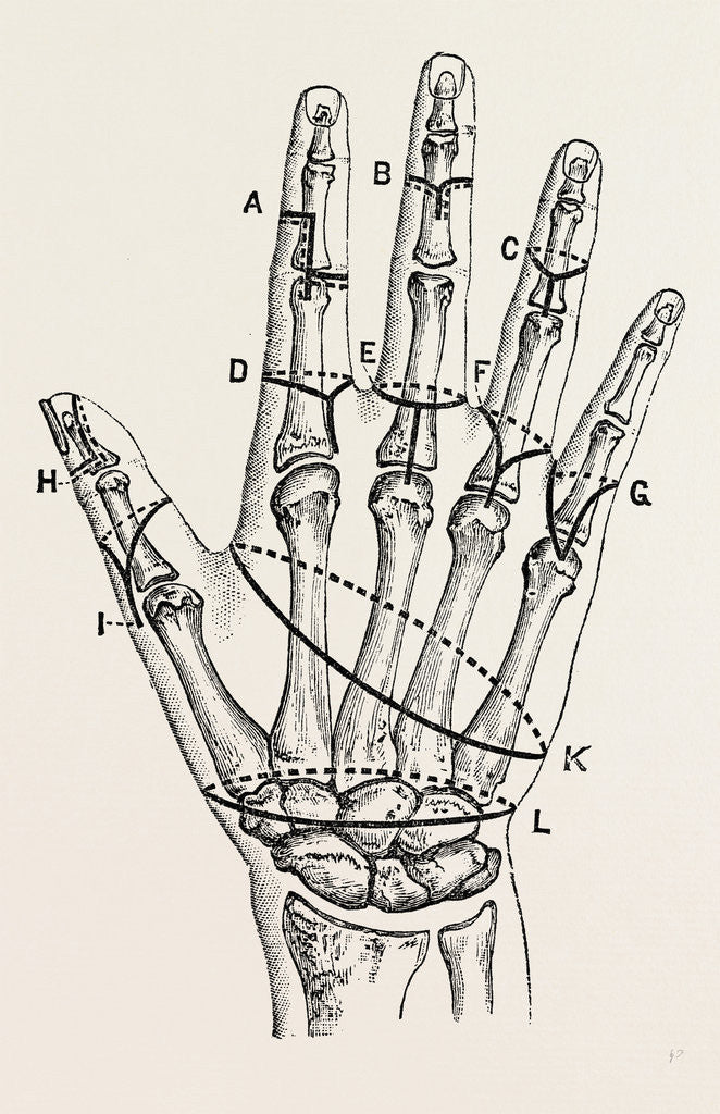 Detail of Disarticulation by single external by Anonymous