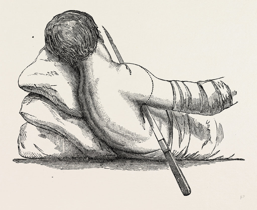 Detail of Amputation at the shoulder-joint by transfixion by Anonymous