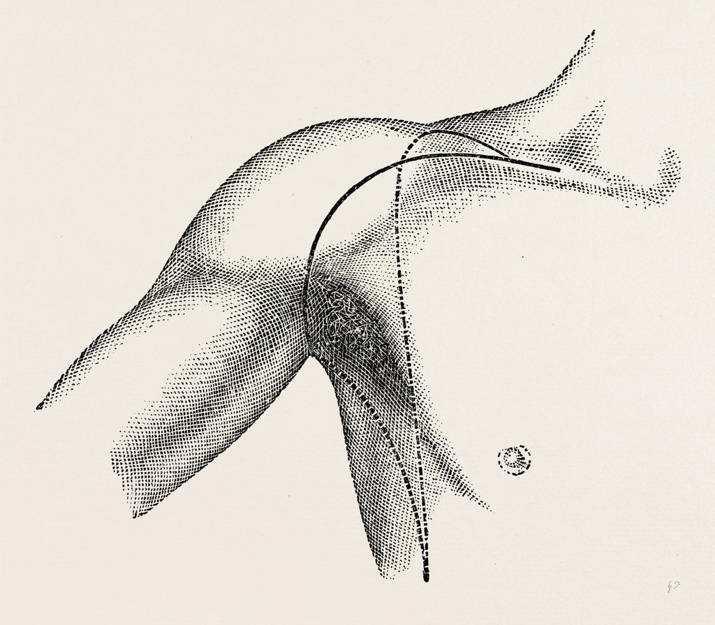 Detail of Interscapulo-tholtacic amputation by Anonymous