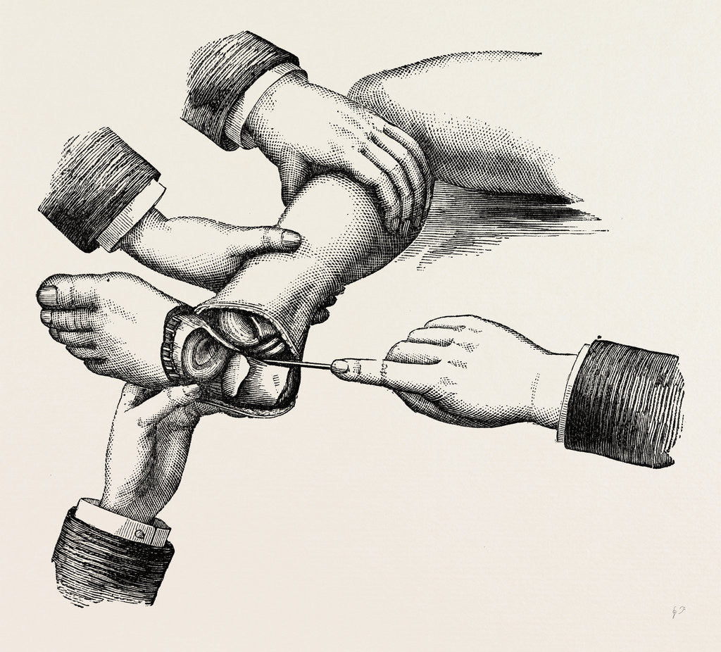 Detail of Subastragaloid amputation of the left foot by Anonymous