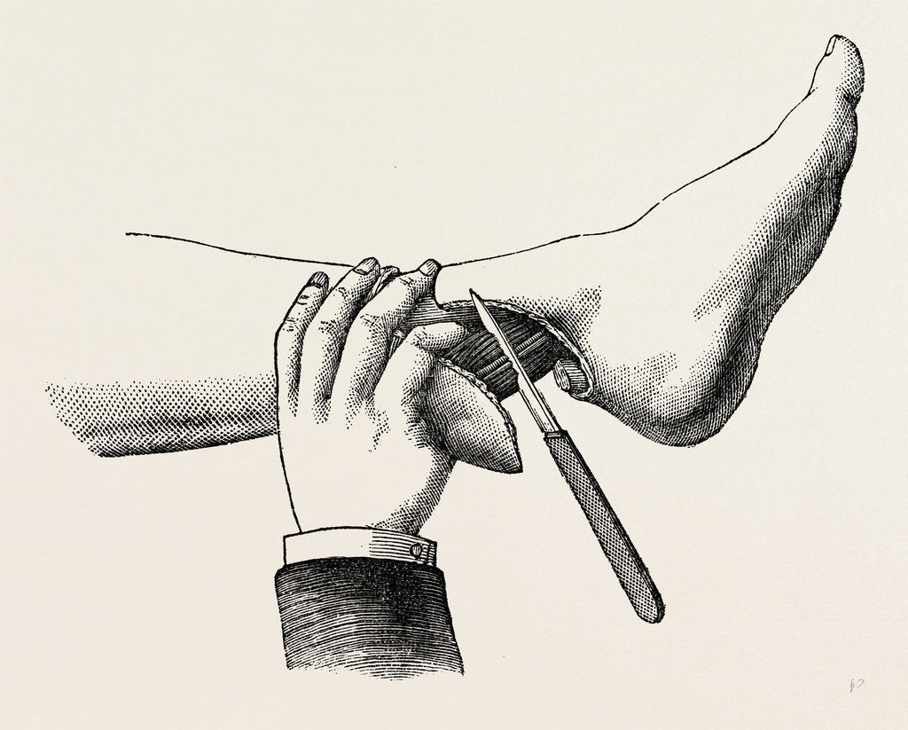 Detail of Mode of dividing the tissues in the amputation by Anonymous