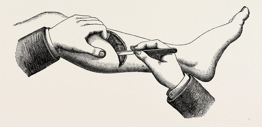 Detail of Mode of cutting the flap in the amputation at 44 by Anonymous