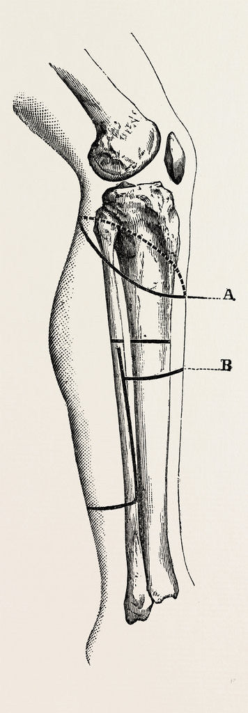 Detail of Disarticulation isarticulation by Anonymous