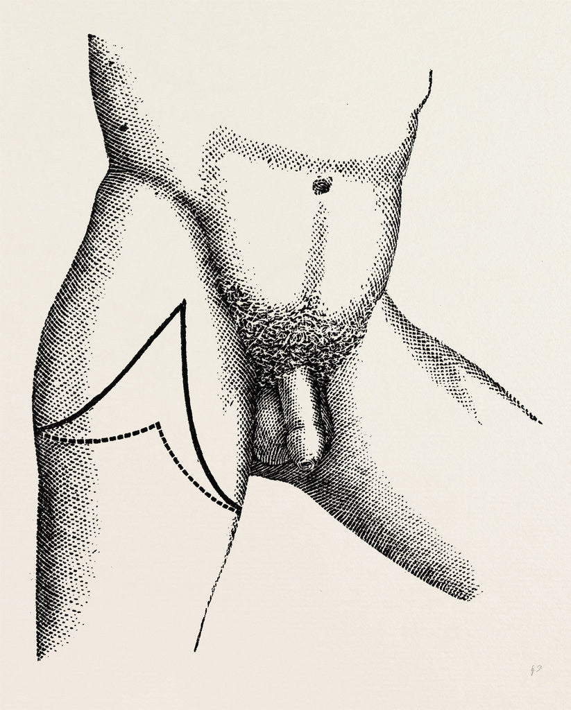 Detail of Lisfrancs disarticulation by Anonymous