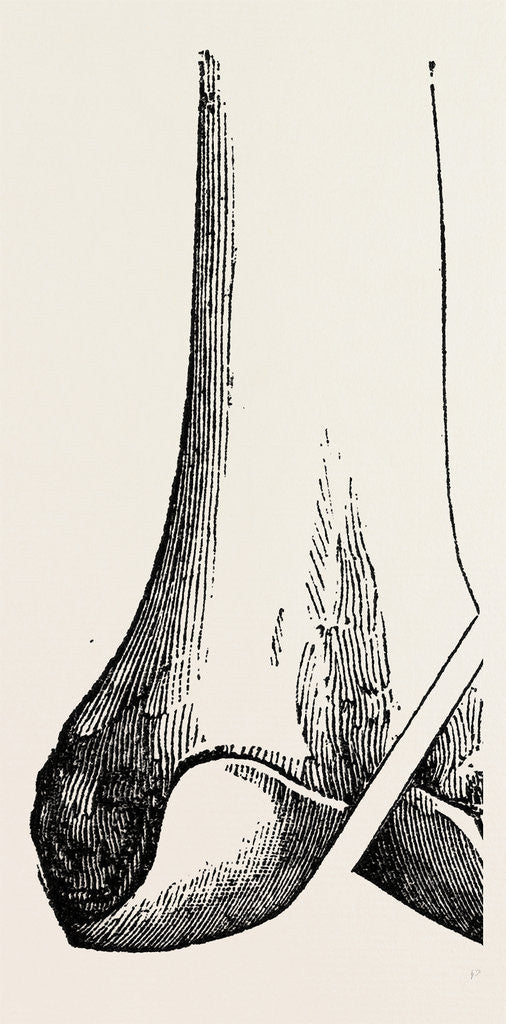 Detail of Ogston's operation by Anonymous