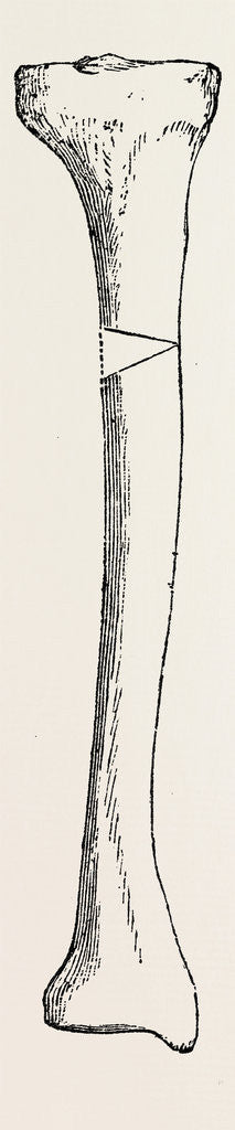 Detail of Diagram representing a curved tibia, with a wedge removed by Anonymous