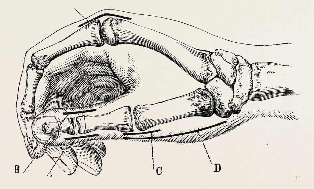 Detail of Excision of metacarpo-phalangeal joint by Anonymous