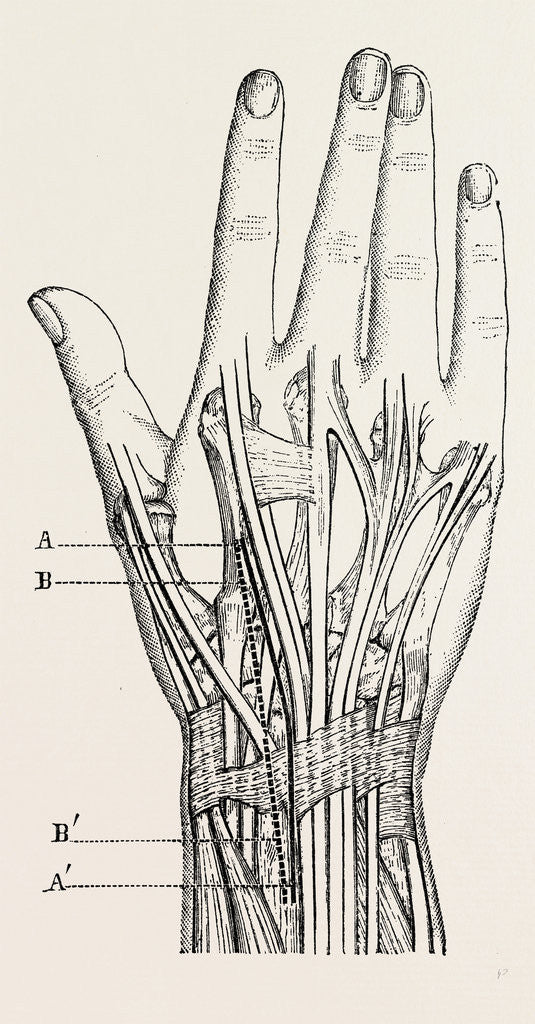 Detail of Excision of the wrist by Anonymous