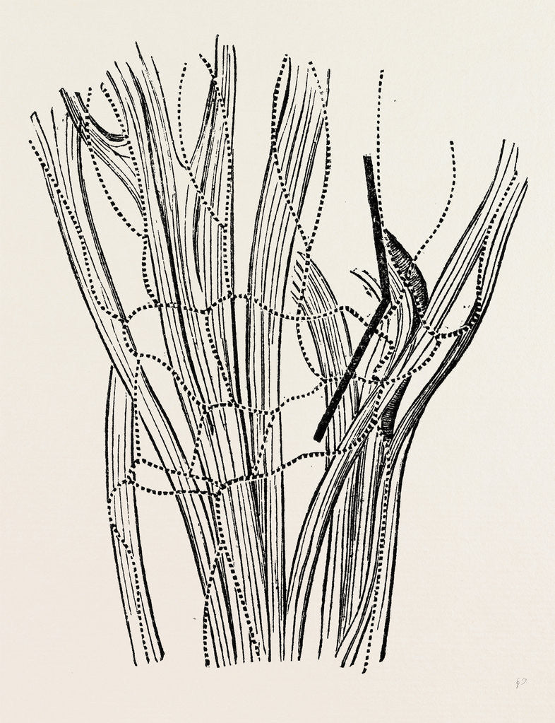 Detail of Excision of the wrist by Anonymous