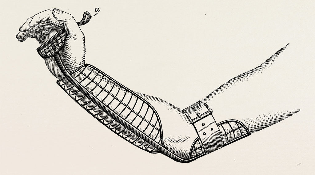 Detail of Ollieris wire splint for excision of the wrist by Anonymous