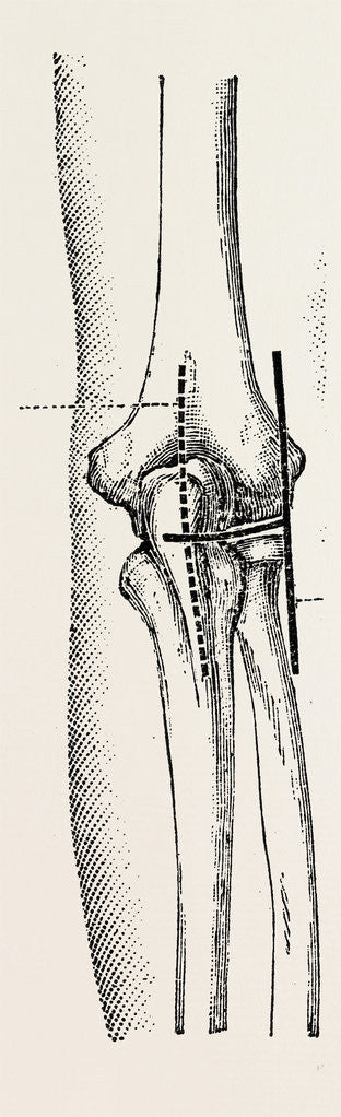 Detail of Excision by Anonymous