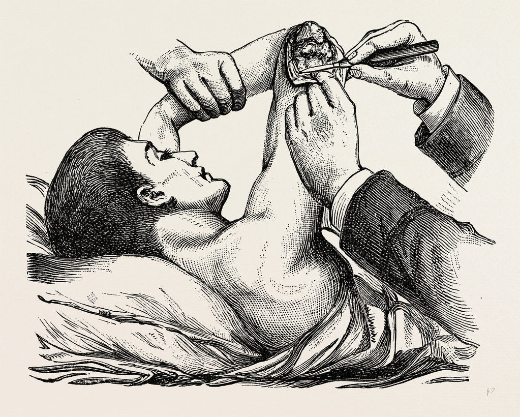 Detail of Excision of the elbow, the clearing of the humerus by Anonymous