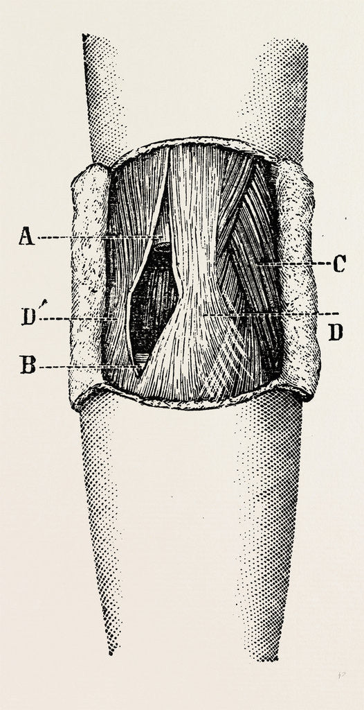 Detail of Right elbow after excision by Anonymous
