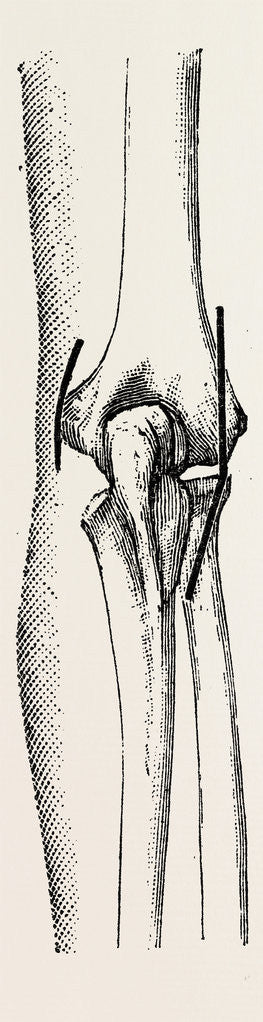 Detail of Excision the elbow is now extended by Anonymous