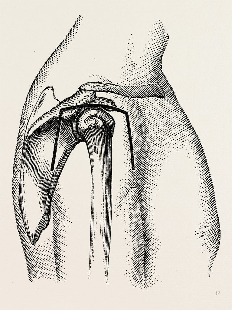 Detail of Excision by Anonymous