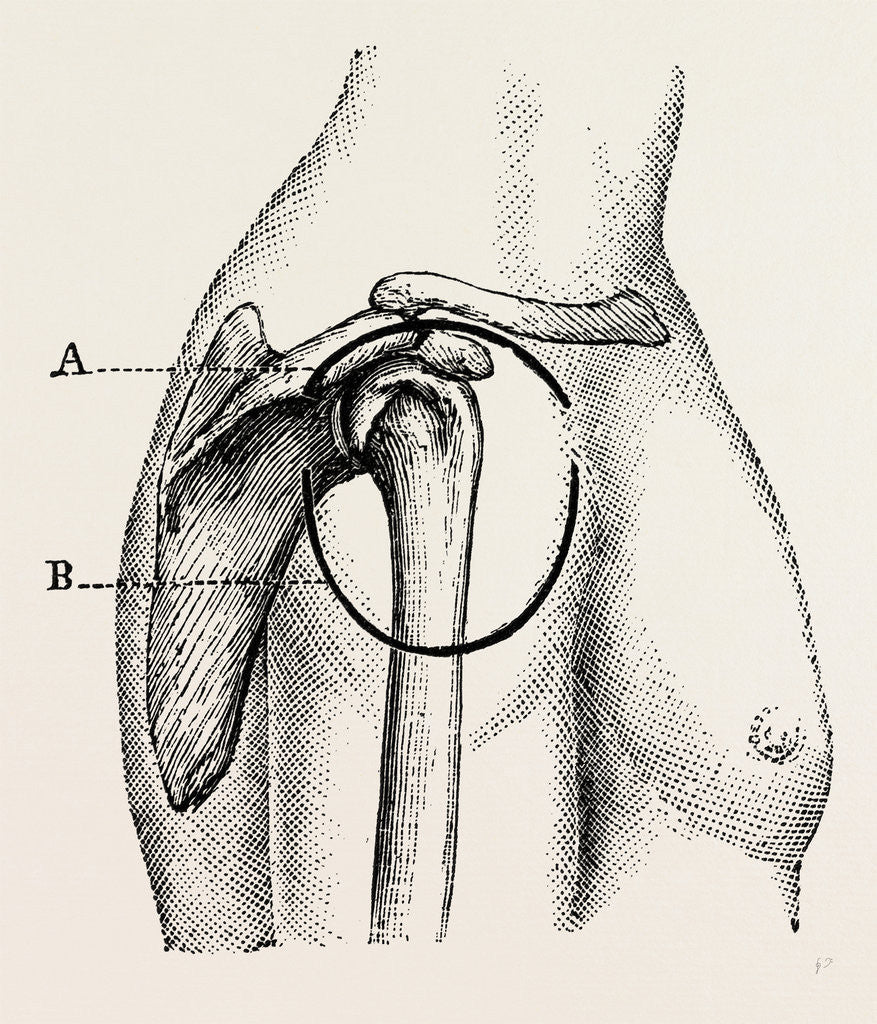 Detail of Excision of the shoulder by Anonymous