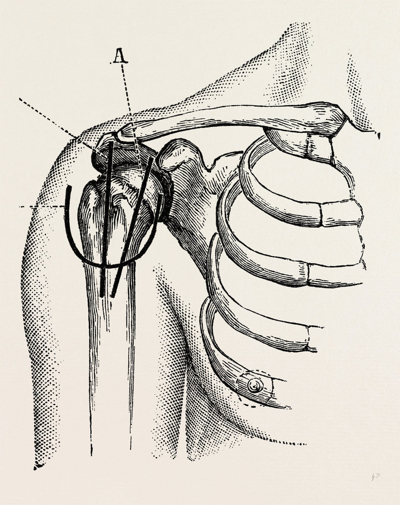 Detail of Excision of the shoulder by Anonymous