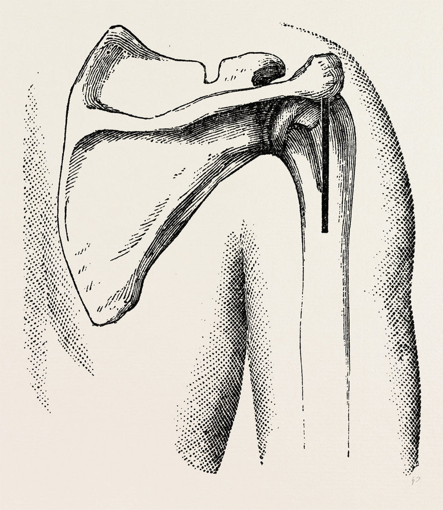Detail of Excision of shoulder by Anonymous