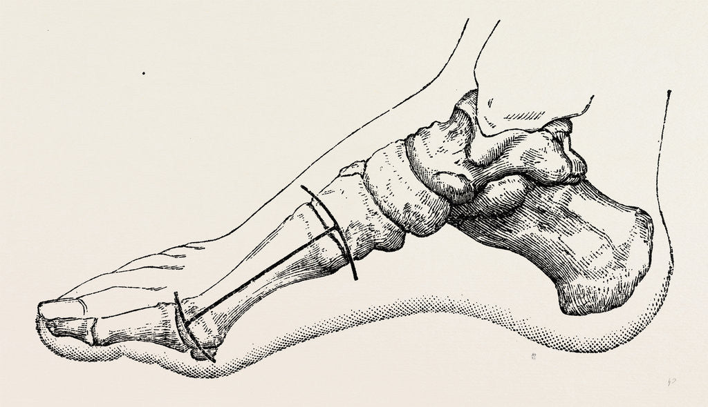 Detail of Excision of first metatarsal bone by Anonymous
