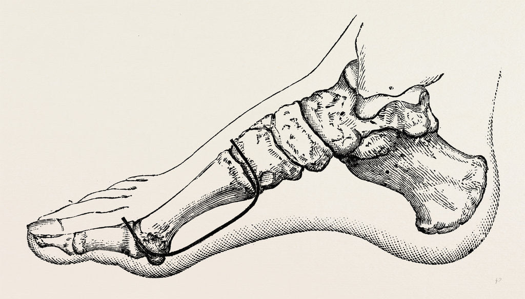 Detail of Eicision of first metatarsal bone, flap by Anonymous