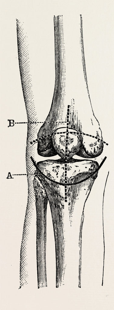 Detail of Excision of the operation the limb by Anonymous