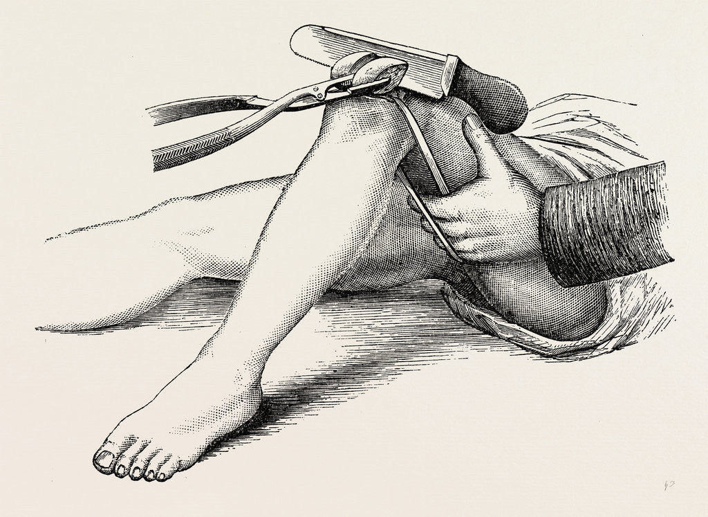 Detail of Excision of the knee, the sawing of the lower end by Anonymous