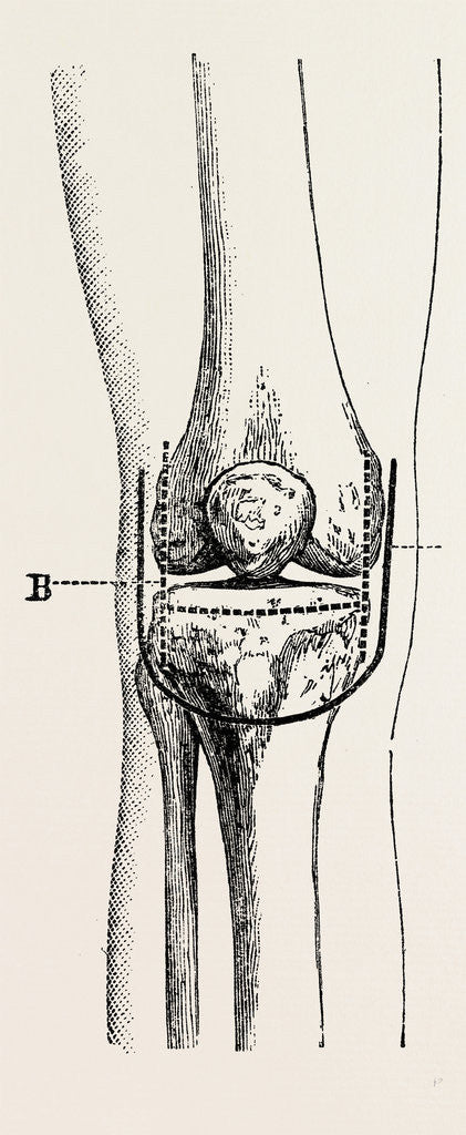 Detail of Excision by Anonymous