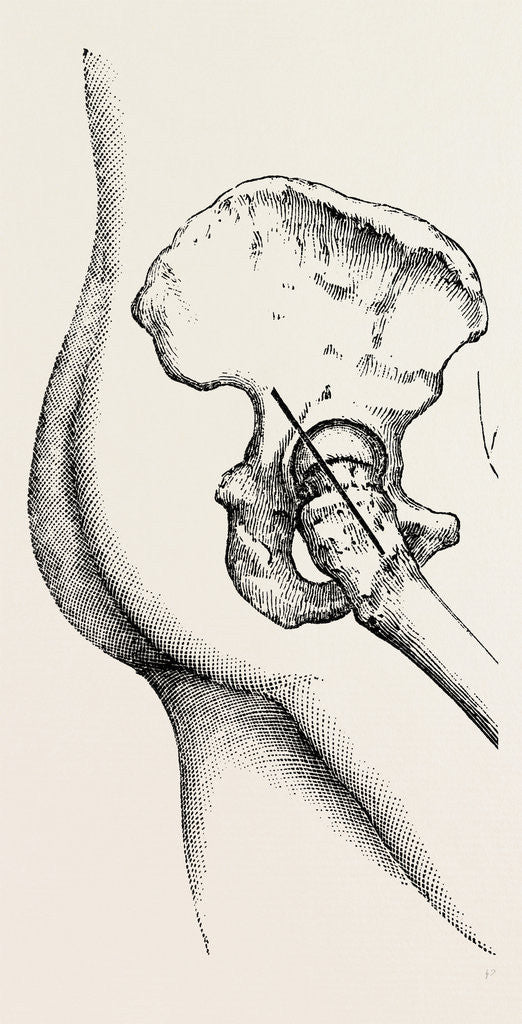 Detail of Excision of the hip by Anonymous