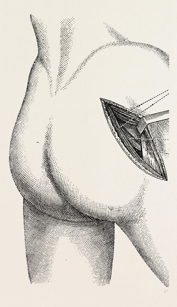 Detail of Excision of the hip by an external incision by Anonymous
