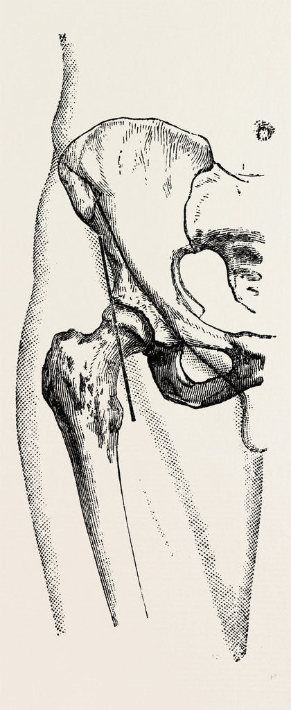 Detail of Excision by Anonymous