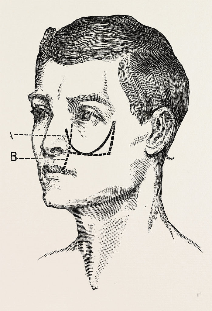 Detail of Excision of the tipper jaw by Anonymous